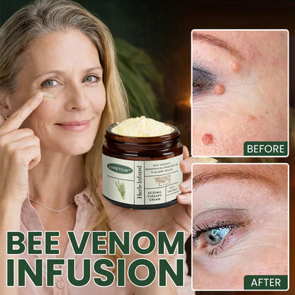 Bee Venom Handmade Premium Tallow Balm – Herb-Infused Eczema Therapy Cream