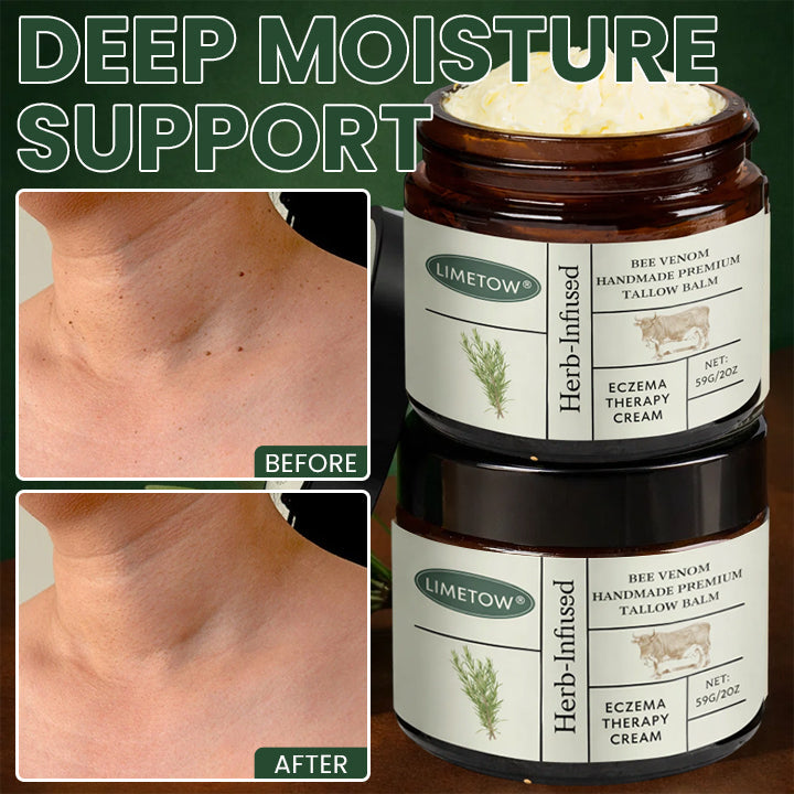 Bee Venom Handmade Premium Tallow Balm – Herb-Infused Eczema Therapy Cream