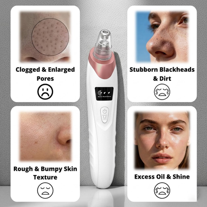 Electric Pore Vacuum & Blackhead Remover – Rechargeable Spot Extractor Tool Set